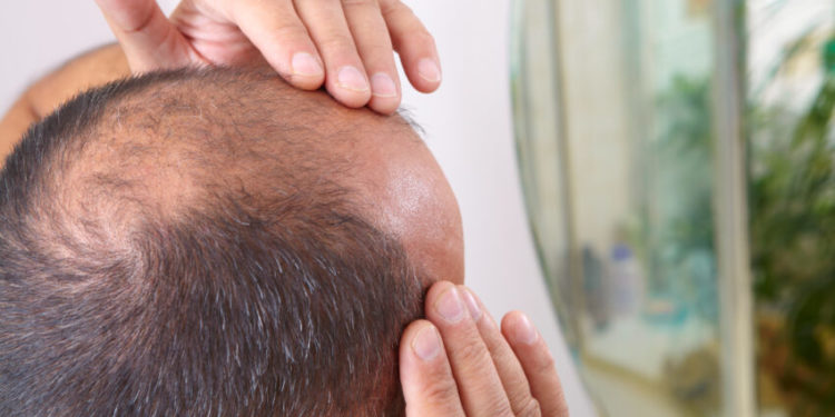 مردوں کو ”گنجا” پکارنا جنسی طور پر ہراساں کرنے کے برابر