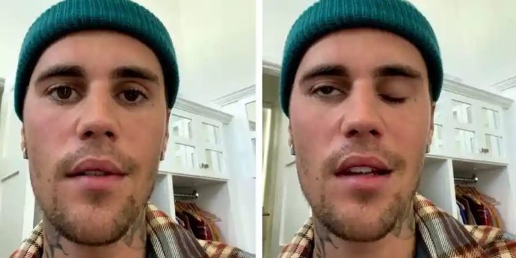 جسٹن بیبر کا آدھا چہرہ فالج کا شکار