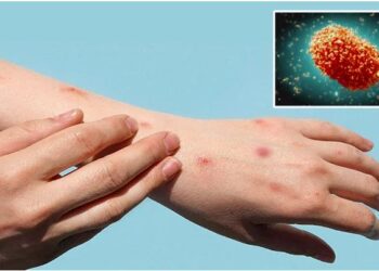 منکی پاکس کی وبا پر این سی اے او سی کا اہم اجلاس